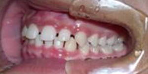 orthodontictherapy_080