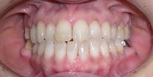 orthodontictherapy_084