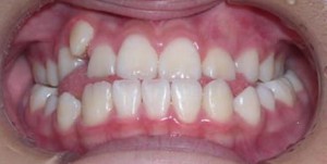 orthodontictherapy_088