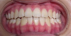 orthodontictherapy_089