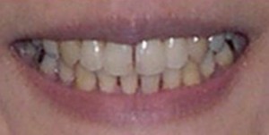 orthodontictherapy_091