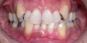 orthodontictherapy_092