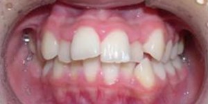 orthodontictherapy_100