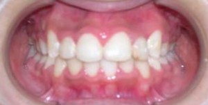 orthodontictherapy_105