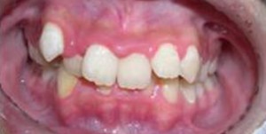 orthodontictherapy_108