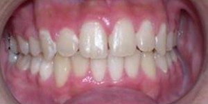 orthodontictherapy_109