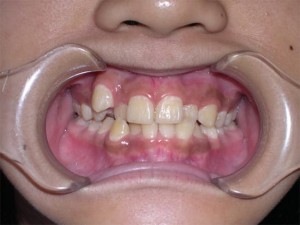 orthodontictherapy_114