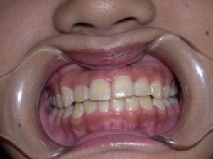 orthodontictherapy_115