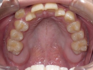 orthodontictherapy_116