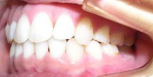 orthodontictherapy_119