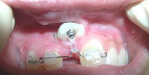 orthodontictherapy_121
