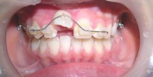 orthodontictherapy_122