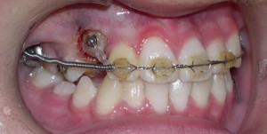 orthodontictherapy_124