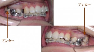 orthodontictherapy_125