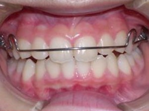 orthodontictherapy_126