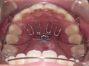 orthodontictherapy_127