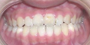 orthodontictherapy_130
