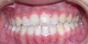 orthodontictherapy_131