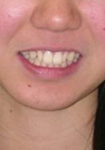orthodontictherapy_132