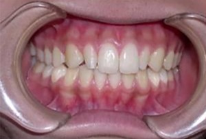 orthodontictherapy_133