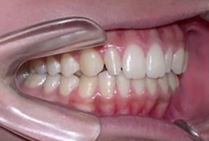 orthodontictherapy_134