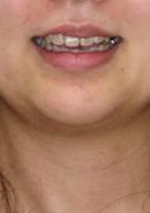 orthodontictherapy_136