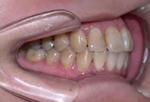 orthodontictherapy_138