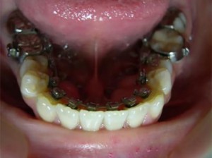 orthodontictherapy_140