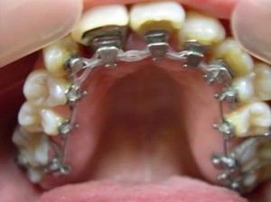 orthodontictherapy_141