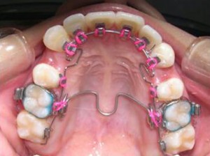 orthodontictherapy_142