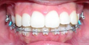 orthodontictherapy_143