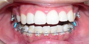 orthodontictherapy_144