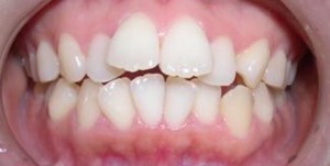 orthodontictherapy_145