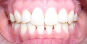 orthodontictherapy_146