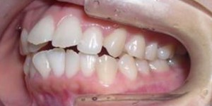orthodontictherapy_147